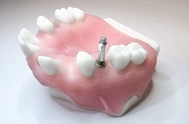 Measure on abutment level